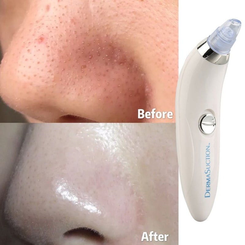 4 IN 1 DERMA VACUUM SUCTION BLACKHEAD/ACNE/OIL/PORE CLEANER