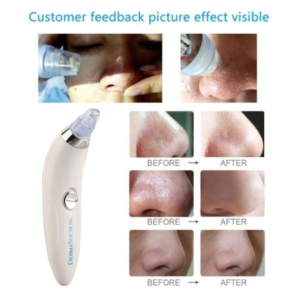 4 IN 1 DERMA VACUUM SUCTION BLACKHEAD/ACNE/OIL/PORE CLEANER